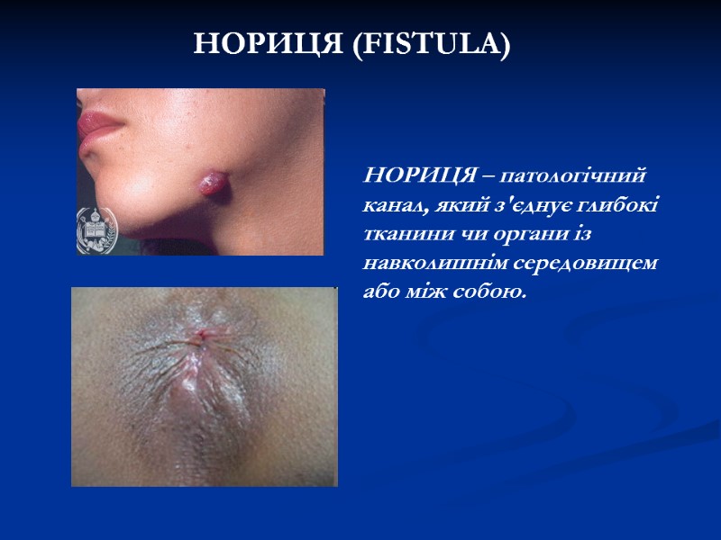 НОРИЦЯ (FISTULA) НОРИЦЯ – патологічний канал, який з'єднує глибокі тканини чи органи із навколишнім НОРИЦЯ (FISTULA) НОРИЦЯ – патологічний канал, який з'єднує глибокі тканини чи органи із навколишнім